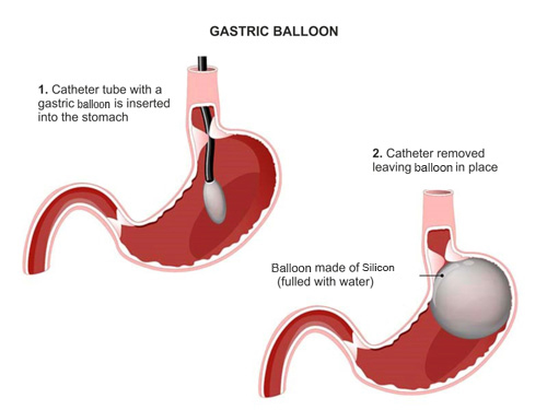 2022 Top 8 Best Surgeons for Gastric Balloon in Istanbul Turkey
