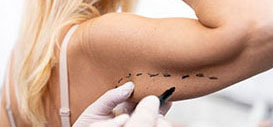 Liposuction (Fat Removal)