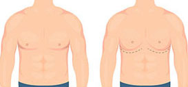 Gynaecomastia