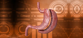 Sleeve Gastrectomy