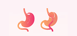 Gastric Bypass