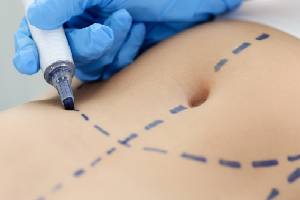 Bariatric Surgery