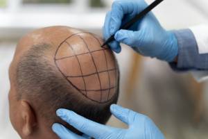 Hair Transplantation